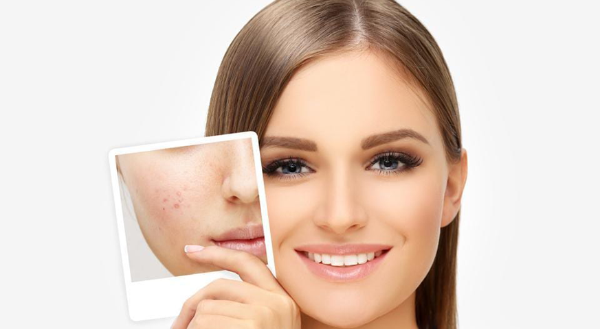 Revolutionizing Acne Scar Treatment: The Ultimate Combination Approach