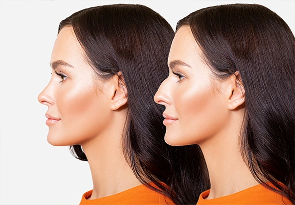   Non-Surgical Nose Job